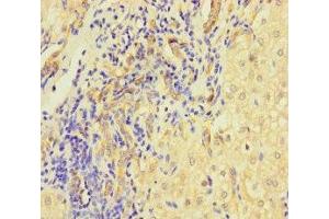 Immunohistochemistry of paraffin-embedded human liver cancer using ABIN7158401 at dilution of 1:100 (L1TD1 antibody  (AA 665-865))