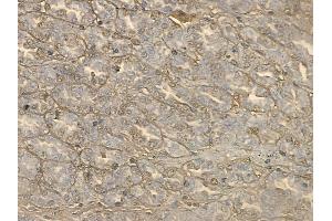 ABIN6264465 and ABIN6272654 at 1/100 staining human renal cell carcinoma by IHC-P. (PSG3 antibody  (C-Term))