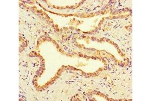 Immunohistochemistry of paraffin-embedded human prostate cancer using ABIN7168168 at dilution of 1:100 (RIOX2 antibody  (AA 1-300))