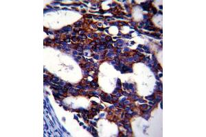 Immunohistochemical staining of formalin-fixed and paraffin-embedded human breast carcinoma reacted with TGFB2 monoclonal antibody  at 1:10-1:50 dilution.