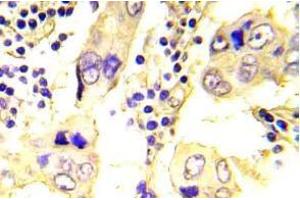 Immunohistochemistry (IHC) analyzes of SRC antibody in paraffin-embedded human breast carcinoma tissue.