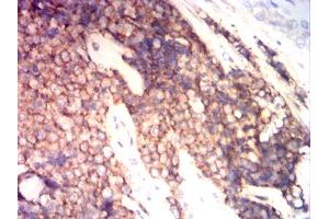Immunohistochemical analysis of paraffin-embedded ewing sarcoma tissues using CD99 mouse mAb with DAB staining. (CD99 antibody  (AA 1-185))