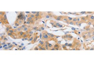 Immunohistochemistry of paraffin-embedded Human lung cancer tissue using MYOD1 Polyclonal Antibody at dilution of 1:120(x200) (MYOD1 antibody)