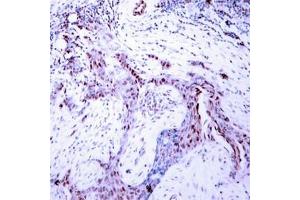 Immunohistochemical analysis of paraffin-embedded human breast carcinoma tissue using Progesterone Receptor(Phospho-Ser190) Antibody. (Progesterone Receptor antibody  (pSer190))