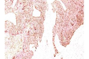 Formalin-fixed, paraffin-embedded human Small Cell Lung Carcinoma stained with Chromogranin A Monoclonal Antibody (LK2H10) (Chromogranin A antibody)