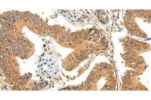 Immunohistochemistry of paraffin-embedded Human colon cancer using SLC32A1 Polyclonal Antibody at dilution of 1:35