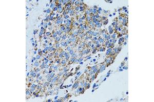 Immunohistochemistry of paraffin-embedded human lung cancer using MRPL28 antibody.