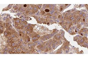 ABIN6276739 at 1/100 staining Human liver cancer tissue by IHC-P. (CD11b antibody  (Internal Region))