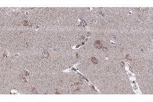 ABIN6276537 at 1/100 staining Human brain cancer tissue by IHC-P.