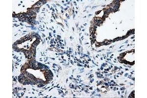 Immunohistochemical staining of paraffin-embedded Adenocarcinoma of colon tissue using anti-SRRmouse monoclonal antibody.
