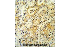 Formalin-fixed and paraffin-embedded human prostate carcinoma reacted with MGST2 Antibody ,which was peroxidase-conjugated to the secondary antibody, followed by DAB staining. (MGST2 antibody  (C-Term))
