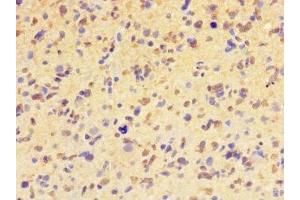 Immunohistochemistry of paraffin-embedded human glioma using ABIN7155399 at dilution of 1:100 (HIST1H2BD antibody  (AA 2-57))