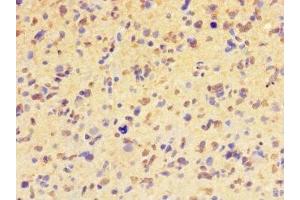 Immunohistochemistry of paraffin-embedded human glioma using ABIN7155399 at dilution of 1:100