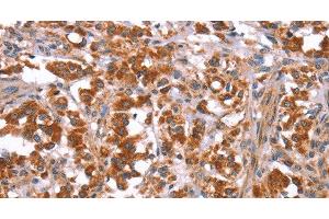 Immunohistochemistry of paraffin-embedded Human thyroid cancer tissue using GLMN Polyclonal Antibody at dilution 1:40 (GLMN antibody)
