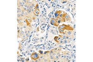 Immunohistochemistry of paraffin embedded human lung cancer using Cdcp1 (ABIN7073600) at dilution of 1:300 (400x lens)