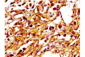 IHC image of ABIN7165944 diluted at 1:100 and staining in paraffin-embedded human melanoma performed on a Leica BondTM system. (PPM1F antibody  (AA 1-76))