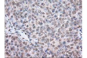 Immunohistochemical staining of paraffin-embedded Human colon tissue using anti-TACC3 mouse monoclonal antibody. (TACC3 antibody)