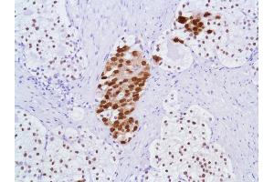 Immunohistochemistry of Human Prostate Adenocarcinoma stained with anti-Androgen Receptor (AR) antibody (Androgen Receptor antibody  (N-Term))