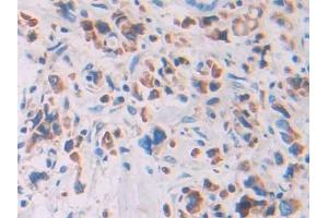 IHC-P analysis of Human Stomach cancer Tissue, with DAB staining. (Ribonuclease A12 (AA 21-147) antibody)
