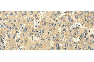 Immunohistochemistry of paraffin-embedded Human liver cancer using PMP2 Polyclonal Antibody at dilution of 1/25 (PMP2 antibody)