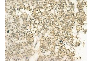 ABIN6257962 and ABIN6274592 at 1/100 staining human pituitary adenoma by IHC-P. (BCOR antibody  (Internal Region))