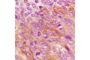 Immunohistochemical analysis of PKR staining in human breast cancer formalin fixed paraffin embedded tissue section. (EIF2AK2 antibody  (C-Term))