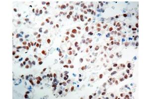 Formalin fixed paraffin embedded Testicular Seminoma stained with OCT4 antibody Cat. (OCT4 antibody)