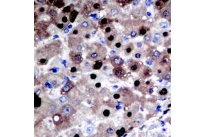 Immunohistochemical analysis of APE1 staining in human liver cancer formalin fixed paraffin embedded tissue section. (APEX1 antibody  (Center))
