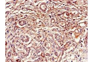 Immunohistochemistry of paraffin-embedded human pancreatic cancer using ABIN7150756 at dilution of 1:100 (DUSP19 antibody  (AA 1-217))