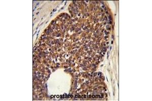 Formalin-fixed and paraffin-embedded human prostate carcinoma reacted with MTBP Antibody (C-term), which was peroxidase-conjugated to the secondary antibody, followed by DAB staining. (MTBP antibody  (C-Term))