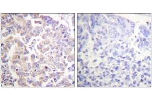 Immunohistochemistry analysis of paraffin-embedded human breast carcinoma, using APC1 (Phospho-Ser688) Antibody. (APC1 antibody  (pSer688))