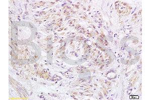 Formalin-fixed and paraffin embedded human cervical carcinoma labeled with Anti-PXMP1/ABCD3/PMP70 Polyclonal Antibody, Unconjugated (ABIN1386868) at 1:200 followed by conjugation to the secondary antibody and DAB staining. (PMP70 antibody  (AA 51-160))