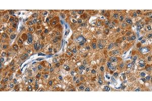Immunohistochemistry of paraffin-embedded Human liver cancer tissue using DRAK2 Polyclonal Antibody at dilution 1:40 (DRAK2 antibody)