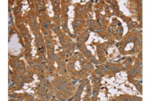 The image on the left is immunohistochemistry of paraffin-embedded Human thyroid cancer tissue using ABIN7192090(RAB14 Antibody) at dilution 1/40, on the right is treated with synthetic peptide. (RAB14 antibody)