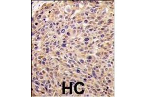 Formalin-fixed and paraffin-embedded human hepatocarcinoma tissue reacted with GGPS1 Antibody (N-term) (ABIN389055 and ABIN2839264) , which was peroxidase-conjugated to the secondary antibody, followed by DAB staining. (GGPS1 antibody  (N-Term))