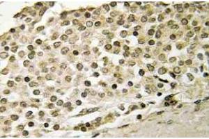 Immunohistochemistry (IHC) analyzes of Cerebral 1 antibody in paraffin-embedded human breast carcinoma tissue. (APP antibody)