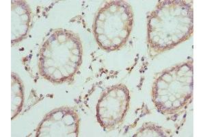 Immunohistochemistry of paraffin-embedded human colon cancer using ABIN7146851 at dilution of 1:100 (CRTAP antibody  (AA 20-240))