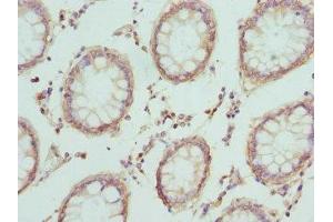 Immunohistochemistry of paraffin-embedded human colon cancer using ABIN7146851 at dilution of 1:100