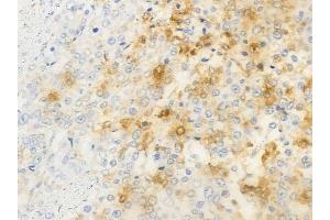 ABIN6263736 and ABIN6266891 at 1/100 staining human prostate carcinoma by IHC-P. (NRIP2 antibody  (N-Term))