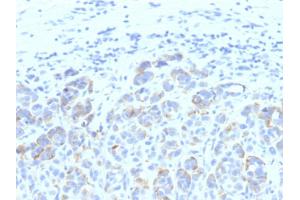 Formalin-fixed, paraffin-embedded human Melanoma stained with TYRP1 MAB (SPM611)