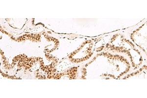 Immunohistochemistry of paraffin-embedded Human thyroid cancer tissue using DGCR6L Polyclonal Antibody at dilution of 1:65(x200)