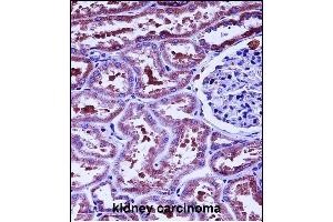 HTRA2 Antibody (N-term) (ABIN657628 and ABIN2846624) immunohistochemistry analysis in formalin fixed and paraffin embedded human kidney carcinoma followed by peroxidase conjugation of the secondary antibody and DAB staining. (HTRA2 antibody  (N-Term))