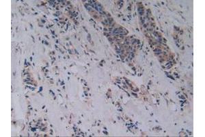 IHC-P analysis of Human Breast Cancer Tissue, with DAB staining. (RANKL antibody  (AA 79-247))