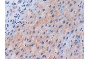 IHC-P analysis of Human Liver cancer Tissue, with DAB staining. (PIK3CB antibody  (AA 807-1070))