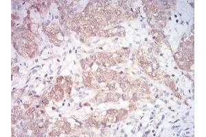 Immunohistochemical analysis of paraffin-embedded bladder cancer tissues using MAP2K3 mouse mAb with DAB staining.