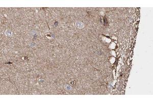 ABIN6279059 at 1/100 staining Human brain cancer tissue by IHC-P. (ABLIM1 antibody  (N-Term))