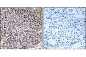 Immunohistochemistry analysis of paraffin-embedded human lung carcinoma tissue, using Cytochrome P450 4B1 Antibody. (CYP4B1 antibody  (AA 141-190))