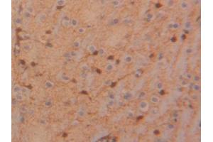 DAB staining on IHC-P; Samples: Rat Glioma Tissue