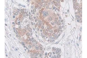 DAB staining on IHC-P; Samples: Human Prostate cancer Tissue (SERPINB5 antibody  (AA 1-375))