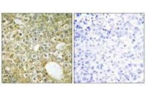 Immunohistochemistry analysis of paraffin-embedded human breast carcinoma tissue using ACVL1 antibody. (ACVRL1 antibody)
